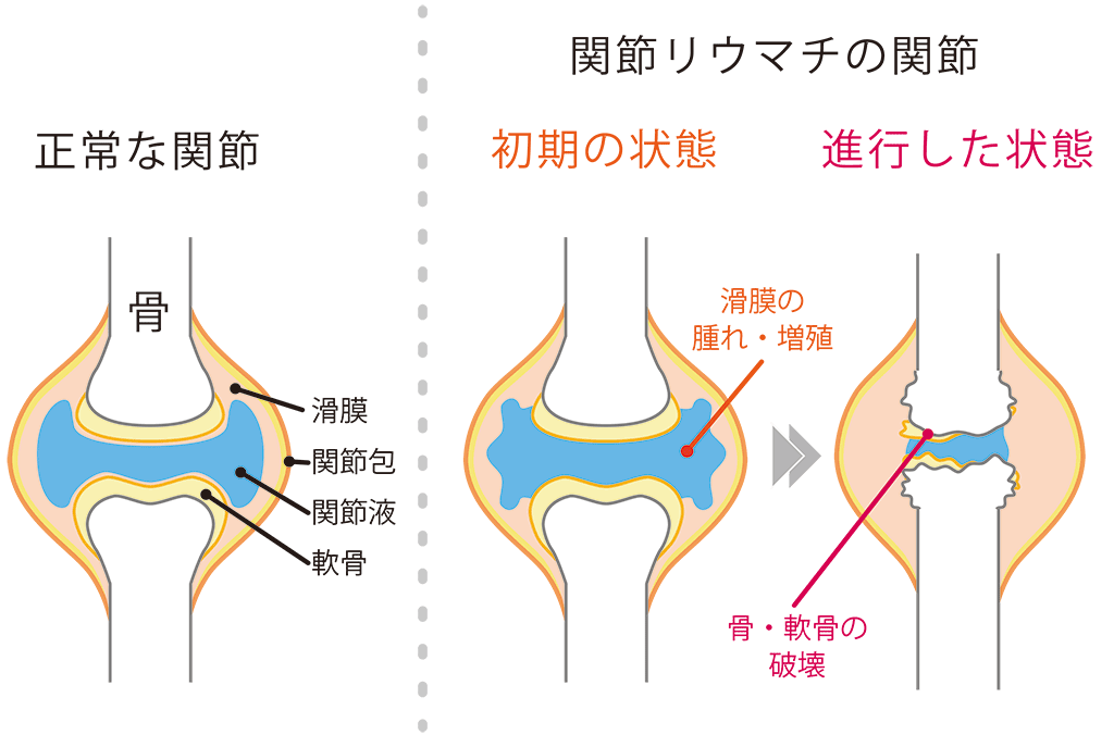 初期 関節 症状 リウマチ